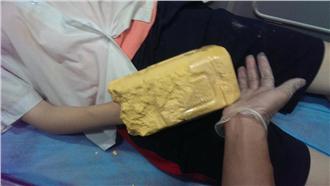 女當手模助大體修復　卻因假貨慘截肢