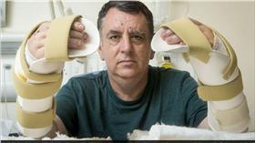 英國首例！男子移植雙手掌成功。（圖／翻攝自《每日郵報》）