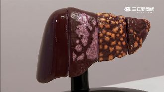 肝癌有解？冷凍治療和癌細胞共存十年