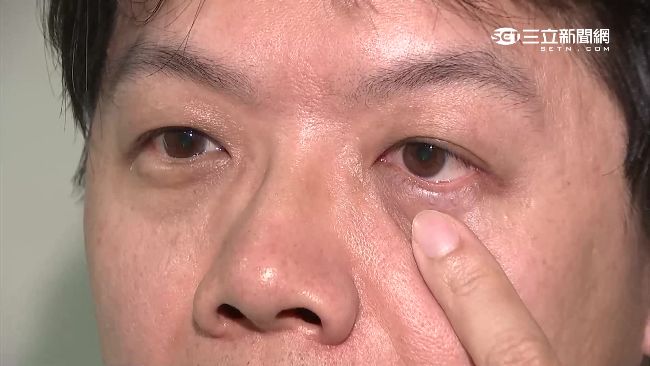 熟女整眼袋竟眼瞼外翻　怒控名醫傷害