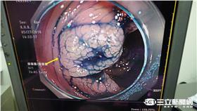 別輕忽！大便習慣突然改變？恐是直腸癌前兆（圖／童綜合醫院）
