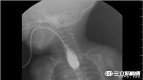 早產女嬰喝水總是嗆到　竟是先天性食道閉鎖