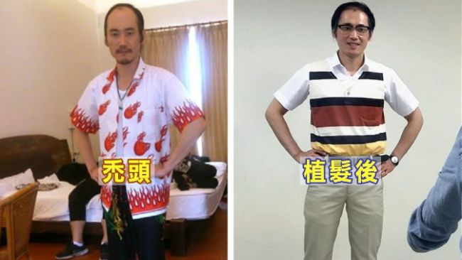 怕「禿頭」斬星途　男藝人砸錢植髮