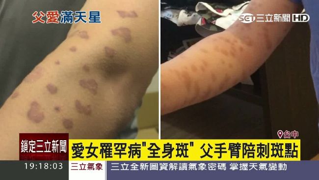 專屬的「小星星」　慈父為愛女刺斑點