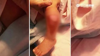 兩歲男童社區跌跤　手腳竟釀二度灼傷