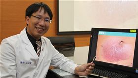 男腹部暗紅斑塊不癒　檢出是蕈狀肉芽腫
26歲林姓男子10多年前發現腹部有暗紅色斑塊，且逐漸
擴大，但無不適症狀，求診時被告知疑似濕疹或過敏反
應，外敷藥膏無效後再求診，才檢出是蕈狀肉芽腫。
（成大醫院提供）
中央社記者張榮祥台南傳真　105年8月24日