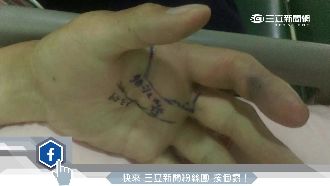 抓眼鏡蛇被咬　連打28針血清仍截肢