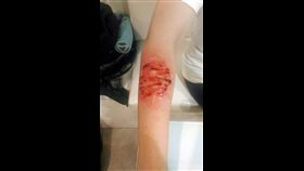 潔哥手臂受傷。（圖／取自潔哥李秉潔粉專）