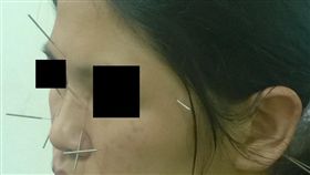 眼疾纏身視茫茫　32歲女東西掉腳邊也不自覺