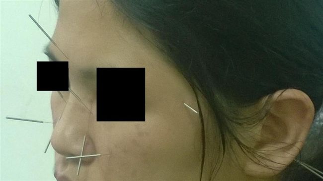 眼疾視茫茫　32歲女講話都不看對方