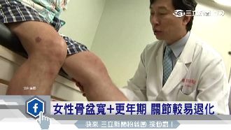 女性易得退化性關節炎　保養靠這兩點