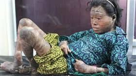 魚鱗病（圖／翻攝自每日郵報）