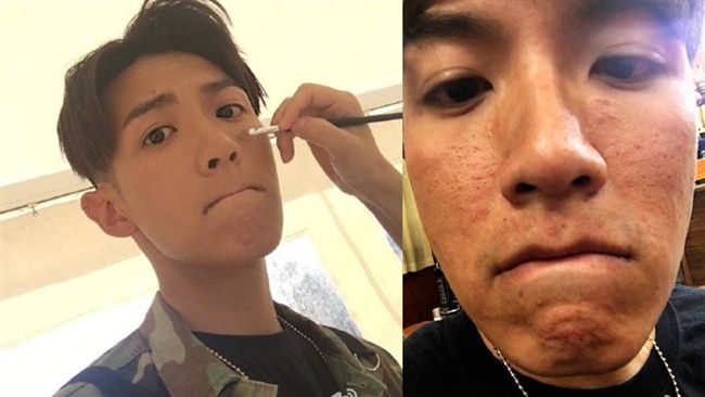 「大爛臉」嚇人　柯震東心酸吐真相