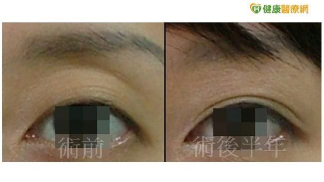 眼窩凹陷飄滄桑　自體脂肪填補變電眼