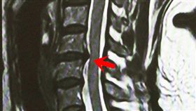 頸椎（圖／中央社）