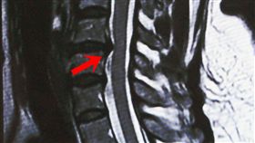 肩關節無力疑罹五十肩  錯誤治療無效反折磨