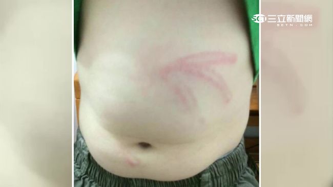 9歲童沒帶作業！遭安親師熱熔膠打傷
