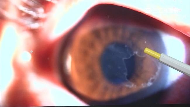 烤肉炭灰入眼狂揉　女角膜破眼險瞎