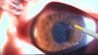 烤肉炭灰入眼狂揉　女角膜破眼險瞎