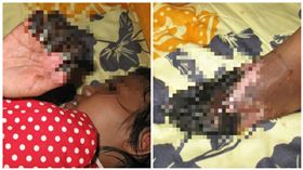 喝牛奶讓手腳變黑？女童細菌感染　父拒截肢保命寧找巫醫
圖/翻攝自新加坡Channel 8網站