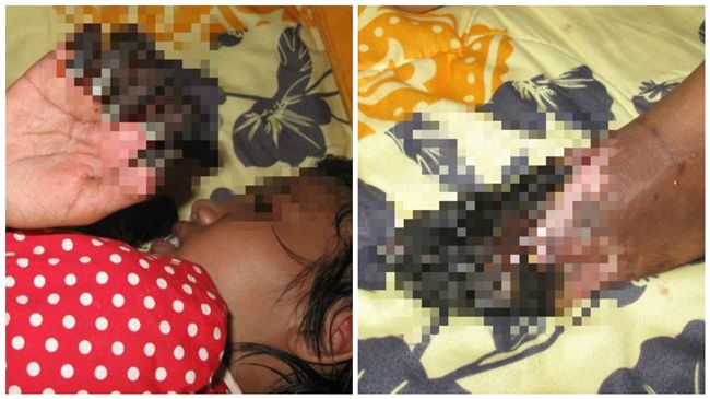 女童喝牛奶手腳變黑　父拒截肢找巫醫
