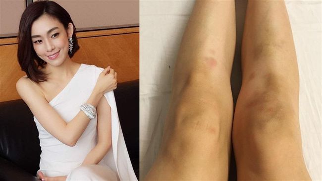 范范遭家暴？　雙腿瘀青兇手竟是…