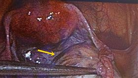 6公分巧克力囊腫作祟　女子結婚5年仍不孕