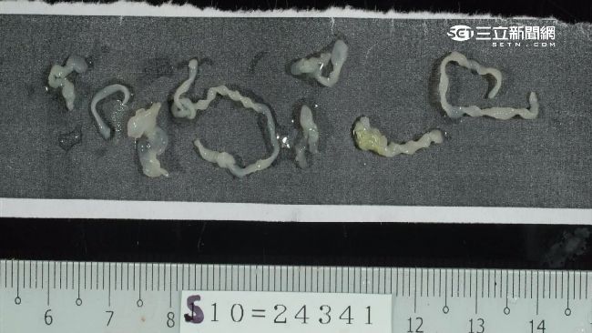喝生水吃生魚片　絛蟲寄生脊髓險癱瘓