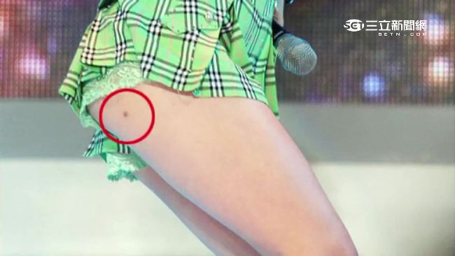 韓女星大腿都有黑點　原來是減肥手法