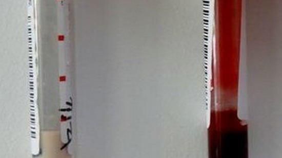 大陸7旬老翁　抽出驚人「牛奶血」
