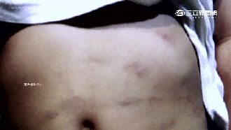 小孩身上多處瘀青　園長扯：收驚就好