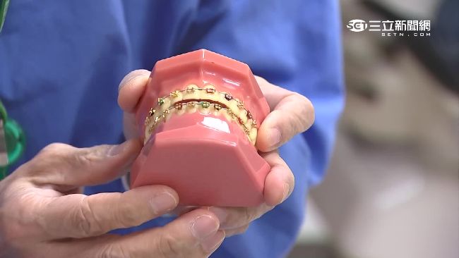 矯正牙套因人而異　數十萬價格落差大