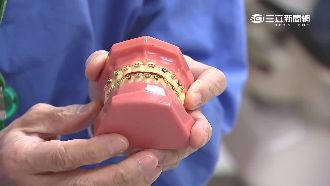 矯正牙套因人而異　數十萬價格落差大
