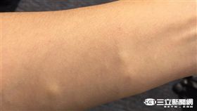 脂肪瘤（圖／資料照）