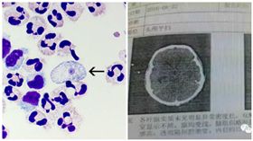 注意！戲水也會致命　浙江壯男感染「吃腦蟲」癱瘓喪命
圖翻攝自美國CDC、深圳新聞網
，http://www.cdc.gov/parasites/naegleria/naegleria-fowleri-images.html