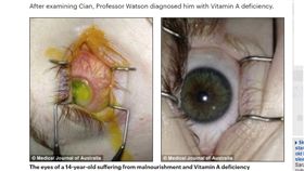 澳洲16歲少年只吃炸雞、薯條　雙眼視力衰退近全盲／每日郵報