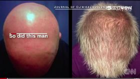 ~禿頭有神藥1800