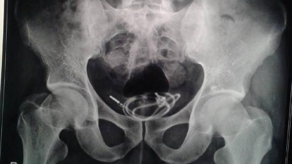插手機線自慰拿不出　男緊急送醫
