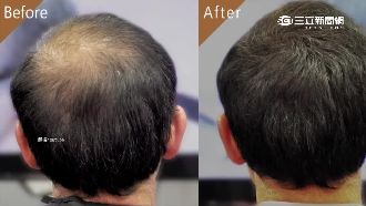 禿頭救星？髮粉「靜電原理」增髮量
