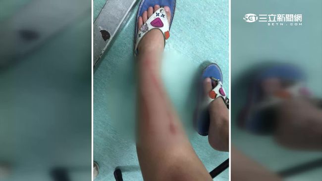水溝蓋鏽蝕到像張紙　女童腿挨18針