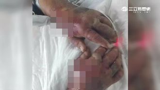 料理活蟹被鉗傷　男雙手紅腫險喪命！
