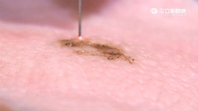 痣的成長速度若太快，或出現其他異狀，應及早就醫檢查。（圖／資料照）