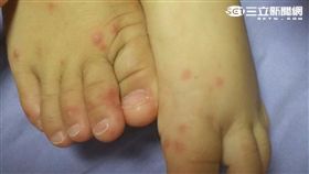 腸病毒疫情升溫！一歲男童反覆發燒無法進食(圖/童綜合醫院)