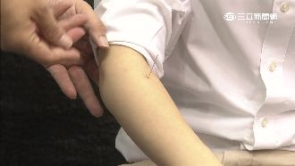 中醫進駐世大運　拔罐、針灸成亮點