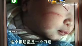 醫剖腹劃傷女嬰臉　竟反怪孕婦肚皮薄