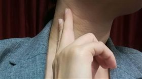 當脖子側面有淋巴結腫大的情形，要提高警覺，可能是甲狀腺癌轉移的情形。（圖／楊晴雯攝）