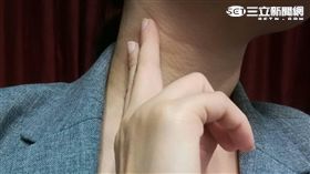 當脖子側面有淋巴結腫大的情形，要提高警覺，可能是甲狀腺癌轉移的情形。（圖／楊晴雯攝）