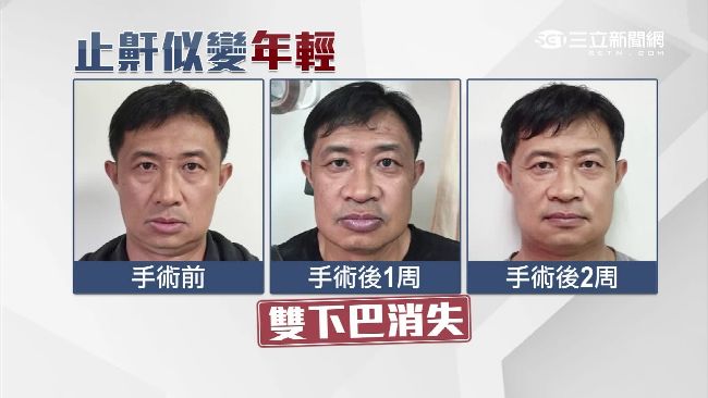 接受睡眠呼吸中止症治療的患者，「止鼾」術後看起來變年輕。(資料畫面)