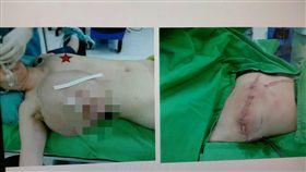 衛福部台南醫院外科醫師莊仁賓10日指出，1名49歲婦女右側乳房腫大，硬塊快速成長，就診時直徑超過25公分，如同足球，確診是邊緣性葉狀腫瘤，取出時重達逾3公斤，非常罕見。（翻攝照片）中央社記者張榮祥台南傳真  105年11月10日