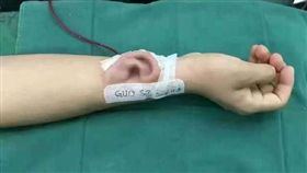 主刀醫師郭樹忠,耳廓手術,自體移植（圖／翻攝自中國日報）